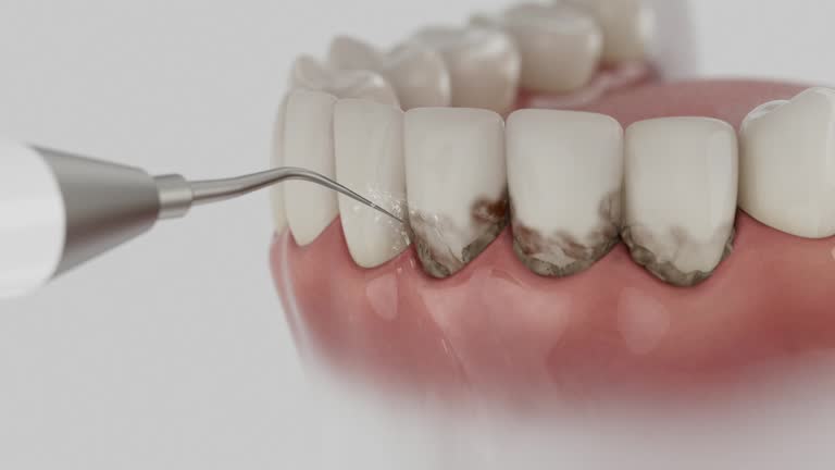 Trusted Teeth Cleaning And Checkup service in Bel-Ridge, MO - Dentist Open Now
